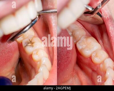 Karies. Befüllen mit zahnmedizinischen Composite photopolymer Material mit Kofferdam. Das Konzept der zahnärztlichen Behandlung in einer Zahnklinik Stockfoto
