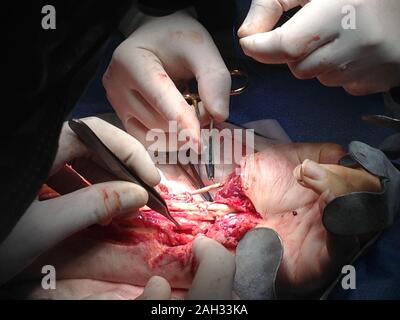 Nahaufnahme einer Rekonstruktion der Chirurgie der Hand, mit vier Händen der Chirurgen. Medizin Konzept Stockfoto