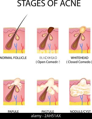Phasen der Akne Bildung in der menschlichen Haut Stock Vektor