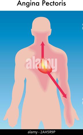 Medizinische Abbildung: die Symptome von einem Angriff der Angina pectoris. Stock Vektor