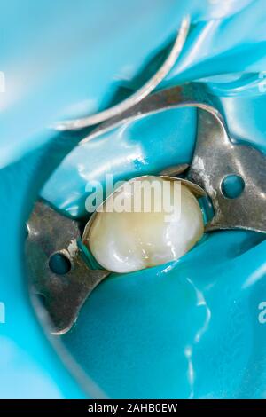 Karies. Befüllen mit zahnmedizinischen Composite photopolymer Material mit Kofferdam. Das Konzept der zahnärztlichen Behandlung in einer Zahnklinik Stockfoto