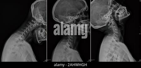 Frau Schwarz und Weiß zervikalen x-ray. Stockfoto