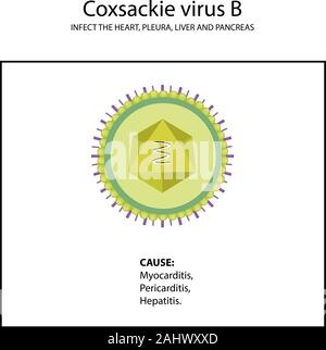 Die Struktur der Coxsackie Virus B. Symptome der Krankheit. Enteroviren. Infografiken. Vector Illustration auf isolierte Hintergrund Stock Vektor