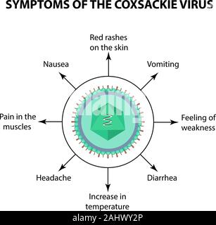 Symptome einer Infektion Coxsackie Virus. Enteroviren. Infografiken. Vector Illustration auf isolierte Hintergrund Stock Vektor