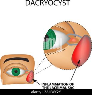 Dacryocyst. Entzündung der lacrimal Sac des Auges. Die Struktur des Auges. Infografiken. Vector Illustration auf isolierte Hintergrund Stock Vektor