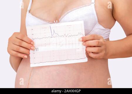 Schwangere Frau mit Ctg Graph in der Hand auf weißem Hintergrund. Warten baby Konzept. Stockfoto