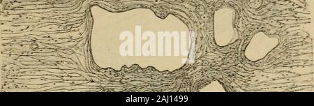 Patologia e terapia delle malattie delle Donne ad uso dei Medici pratici. Abb. 182. - Salpingite interstiziale (orthmann) Hartnack Oc. 2; obb. 4-m-Schleimhaut; m, muscolare. s%. 311 Stockfoto