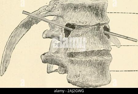 Saint Louis medizinische und chirurgische Journal. el, die gefunden wurde, nahezu frei von j^uns, legen Sie die flexible catheterintroduced in die Wunde bei Beginn der Autopsie; seine Extremität wurde gefunden, der sich selbst verdoppelt, das Bauchfell, Iejjosing immediatelybeneath ujjon der fascia Iliaca, wherethe Kanal in eine Tasche oi beträchtliche Größe geweitet wurde. ThisJong - absteigend Kanal, jetzt wirklich gesehen causedby zu t^e buriowing von Eiter aus der Wunde wurden, war duringlife das Verfolgen der Bullet worden sein soll. Die letzte dorsale, togetiier mit dem Ersten und Zweiten vertebraeAnd der zwölften Rippe, w Stockfoto