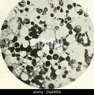 Die Medizinischen Kliniken in Nordamerika. Abb. 86. - RECHTSSACHE III. Tibia Knochenmark. Purpura haemorrhagica. Diese marrowhas ein paar Zellen. Definitiv nicht fetthaltigen Knochenmark. Mit Bild vergleichen. 84. sichtlich, dass Ansätze etwas die Aplastische Anämie Typ. Viele der berichteten Fälle des Wahren idiopathischen Typ werden durch Transfusion erwiesen und genießen Remissionen in der Sie feelfairly gut. Bluttransfusionen waren von geringem Erfolg hier. Unser Ziel in den oben genannten Fällen war zu atten Call-tion auf bestimmte Abweichungen von der Art, dass tooccur in den drei Gruppen von Krankheiten stellen unter Berücksichtigung gebunden sind. ST Stockfoto