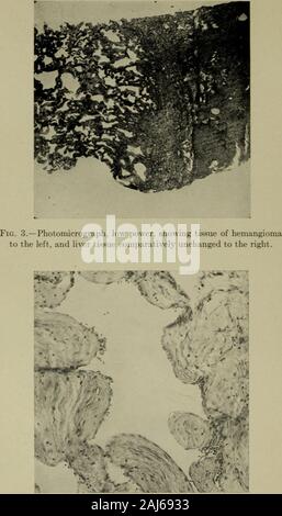 Transaktionen des Südlichen chirurgische und gynäkologische Vereinigung. Abb. 2.-Foto von Tumor schneiden und legte Öffnen.. Abb. 4.-Photomicrograph, hohe Leistung, zeigt die Struktur der fibroussepta und Endothelzellen, Verstärkung der Großen höhlenartigen Räumen. Stockfoto