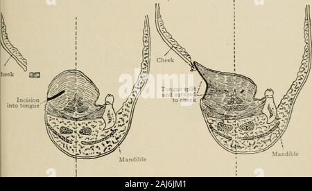 Plastische Chirurgie; ihre Grundsätze und Praxis. larartery. Die lange pedicles dieser Klappen, nach durchtrennt werden, Shouldbe auf ihre ursprüngliche Position (Feigen zurück. 689-690). Willard Bartlett 1907 verwendet, um die Zunge für sofort closinga Defekt in der Wange nach Exzision eines bösartigen Wachstums von themucous Membran. Der größere Teil der Schleimhaut mas sowie einen Abschnitt, der die volle Stärke der Wange, wurde herausgeschnitten. Die Seite der Zunge gespalten längs und die Kanten vernäht waren "Ich CHIRURGIE DER WANGE 587 an den Rand des Mangels. Die oberflächlichen Geweben des c Stockfoto