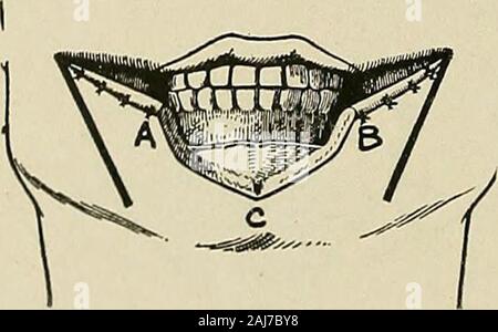 Plastische Chirurgie; ihre Grundsätze und Praxis. Abb. 591.- für den Wiederaufbau der Unterlippe mit seitlichen Klappen (Berger).-I und 2. Kontinuierliche Einschnitte mit dem commissures werden auf jeden^ Seite und themucous Membran und Haut sind miteinander vernäht.. Stockfoto