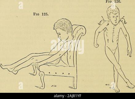 Ein Handbuch von Krankheiten des Nervensystems. wermay verloren gehen oder bleiben, auch wenn die spastische Paraplegie eine hohe hasreached. Die Ernährung der Haut und Gelenke unter - keine Änderung. Okuläre Symptome sind selten, mit Ausnahme der Nystagmus, whichwill oft gefunden werden, wenn gesucht. Die Aktion der Schüler isusually perfekt, und ich habe nur einmal Sehnerv Atrophie in anuncomplicated Fall gesehen. Die infantile Form kann sehr eng ähneln, dass die Auftritt Inadults. Es sind die gleichen extensor Krampf und Erhöhung der alle formsof Reflex Action. Da sitzt das Kind auf dem Knie oder ein Stuhl Stockfoto