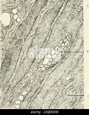 Das Journal der Nerven- und Geisteskrankheiten Krankheit. Ween interne und externe Internum; eine kleine Gruppe ofmuscles Fasern (wie in einer Probe 10) surroundedby eine Schicht aus Bindegewebe voll so breit wie die noch-mals Internum externum. Diese letzteren, der Erkrankten Muskel, durch thepresence der Arterien und Venen unübersehbar, und von zwei Arten von bundlesof faserartigen Bindegewebe, das eine sein Die delicatefibrous Gewebe wie in normalen Muskel gesehen, und der secondbeing Breite und Dichte, ähnelt die faserige connectivetissue von aponeuroses und fasciae. Neben dieser, die Internum externum ist, Stockfoto