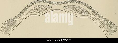 Chirurgische Behandlung; eine praktische Abhandlung über die Behandlung von chirurgischen Erkrankungen, für die Verwendung von Praktikern und Studenten der Chirurgie. Abb. II 75.- Diagramm der Querschnitt der vorderen Bauchwand abovethe Taschenklappen Falten von Douglas.. Abb. 1176.- Diagramm der Querschnitt der vorderen Bauchwand unter der Falte von Douglas. Stockfoto