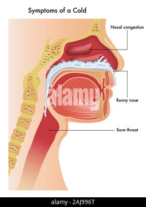 Eine medizinische Illustration der der oberen Atemwege einer Person mit den Symptomen einer Erkältung. Stockfoto