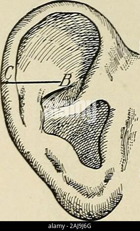 Plastische Chirurgie; ihre Grundsätze und Praxis. Abb. 403.- für die Sanierung des lobule hnodified aus Xelaton und Ombre - danne). i, 2 und 3. Aflapconsiderably breiter als der Mangel zu besetzenden Stellen wird von theskin hinter dem Ohr, mit seinen PEDICLE auf der Haut des Halses, auf einer Linie mit dem Gehörgang. Die Klappe wird angehoben und die freie Kante ab, um die belebte Defekt an den Hals vernäht wird. Ein rollof iodoform, Gaze ist unter der Klappe platziert. Die Wunde am Hals ist Vernäht. 10 dayslater der pedicle gekappt und die Klappe wird in selbst gefaltet, rohe Oberfläche roh Oberfläche, unddem e Stockfoto