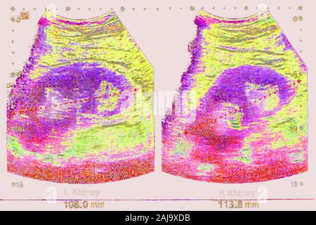 Kidneus Ultraschall Stockfoto