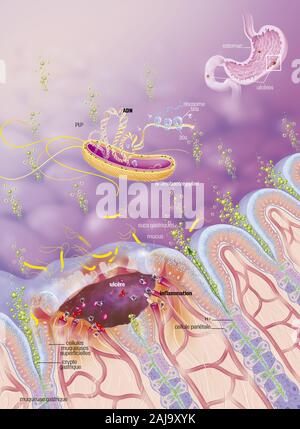 Ulcere gastroduodenalen Stockfoto