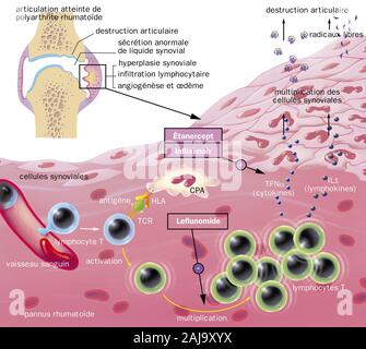 Zerstörung des Gelenks, synovial Hyperplasie, Angiogenese, Ödeme, Lymphozyten Infiltration, Behandlungen. In der linken oberen Ecke ist eine gemeinsame in Kapite gesehen Stockfoto