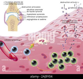 Zerstörung des Gelenks, synovial Hyperplasie, Angiogenese, Ödeme, Lymphozyten Infiltration. In der linken oberen Ecke ist eine gemeinsame in Abschnitt gesehen mit Artic Stockfoto