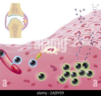 Zerstörung des Gelenks, synovial Hyperplasie, Angiogenese, Ödeme, Lymphozyten Infiltration. In der linken oberen Ecke ist eine gemeinsame in Abschnitt gesehen mit Artic Stockfoto