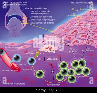 Zerstörung des Gelenks, synovial Hyperplasie, Angiogenese, Ödeme, Lymphozyten Infiltration, Behandlungen. In der linken oberen Ecke ist eine gemeinsame in Kapite gesehen Stockfoto