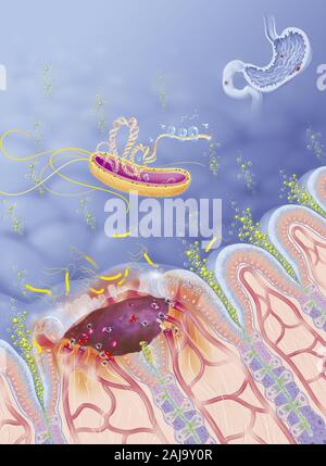 Ulcere gastroduodenalen Stockfoto