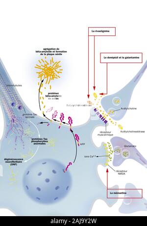 Mit neurofibrilläre Degeneration Prozess Neuron, senile Plaques, Behandlungen. Neuron im zentralen Nervensystem durch abnorme Spaltung von APP betroffen Stockfoto