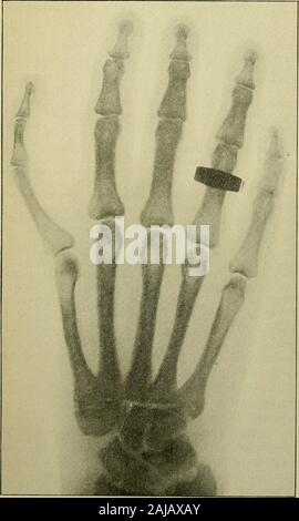 Medizinische und chirurgische Berichte. wicklung der entsprechenden Humerus, Schlüsselbein andscapula. Diese Patienten, die Fotografie ist in Abb. 1 gezeigt. 12, skiagramof der Unterarm in Abb. 13 Und die Schulter in Abb. 14. Der patient Wasa junge Frau, 17 Jahre alt, deren Familiengeschichte kindlyfurnished wurde von meinem Kollegen, Dr. Horace Arnold. Vier Brüder livingin Nova Scotia waren alle verheiratet und hatte Kinder, mehr oder weniger von whomwere verformt. Jonathan H. hatten acht Kinder, von denen einer, Celia S., der motherof Fall VI., einen überzähligen Phalanx in den Daumen hatte. Ihre Hand amschild in Abb. 15. Die zweite Bro Stockfoto