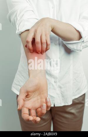 Anzeichen von Dermatitis und Schabies. Frau kratzt sich an den Händen. Hautallergie. Stockfoto