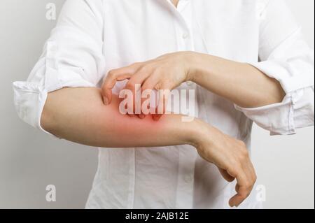 Anzeichen von Dermatitis und Schabies. Frau kratzt sich an den Händen. Hautallergie. Stockfoto