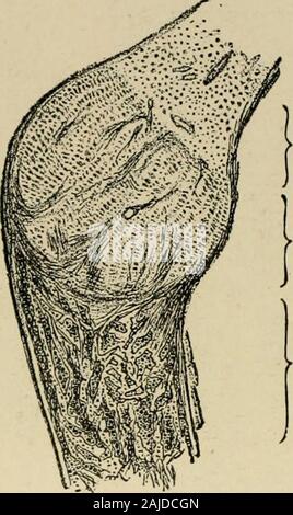 Die Erkrankungen von Säuglingen und Kindern. , Die Leiden in der Folge von Grün-stick Frakturen, mit theproduction aus einer großen Menge von schwiele. 590 DIE KRANKHEITEN DER KINDER während der Genesung von der Krankheit der knöcherne Veränderungen verschwinden throughresorption und Kondensation des unvollkommenen Knochen statt, und Hme-Salze sind wieder abgelagert. Die Entwicklung von sehr harten, kompakte, dichte, knöchernes Gewebe (eburnation) Ergebnisse. Kurz, die knöchernen Veränderungen der Rachitis bestehen in ungewöhnlichen Hyperämie; übermäßige Verbreitung von Knorpel; Unregelmäßigkeiten in der Transformation ofcartilage in den Knochen, mit disturbanc Stockfoto