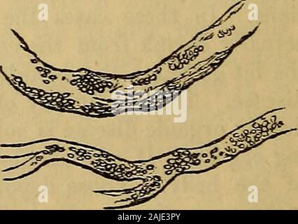 Hooper ist der Arzt Vade Mecum, oder ein Handbuch zu den Grundsätzen und der Praxis der Physik. dtogether oder in runden oder ovalen Cluster, * wie große Grieß-Zellen. Die subjoinedengraving, von einem Papier von Herrn Paget, inder London Medical Gazette, 1850, zeigt das Aussehen eines smallartery unter diesem fonn der Degeneration. 351. Die Wirkung dieser Ablagerung von Öl- Kügelchen ist, dass der sogar outlineof der Schiffe ist für eine verknotete Aussehen ausgetauscht, und dass ihre Abfälle und properstructures allmählich verschwinden, so dass die kleineren vesselsdilate in Minute aneurismal Beutel. Die ordnungsgemäße vaskuläre Struk- tur Stockfoto