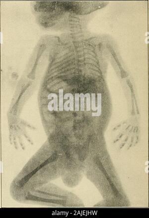 Theorie und Praxis der Säuglingsnahrung, mit Hinweisen auf die Entwicklung. 298 SÄUGLINGSNAHRUNG.. Abb. 88.- rontgen Bild eines Kindes nach neun Wochen. gefördert. Die Knochen der Beine wachsen andstraighten heraus, aber dies wird gestört, wenn die babyis gemacht das Gewicht des Körpers zu früh zu fördern. Das Wachstum von Säuglingen. 299 Die durchschnittliche Baby sollte nicht gefördert werden, um standbefore im zwölften Monat; Bemühungen zu gehen kann begunfrom dann zum fünfzehnten und sechzehnten Monats. Wenn man zu Fuß wurde die Beine bestraight sollte. Die Brust entwickelt sich rasch, mit der pector enlargementof Stockfoto