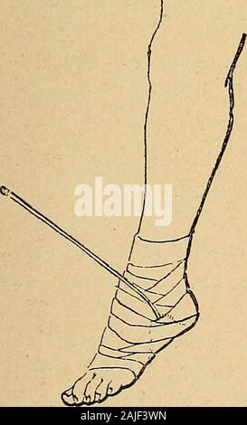 Technik du traitement des tumeurs Blanches. Abb. 164. - Notre levier - chaussure gießen Abb. 165. - Applica-Abb. 166. - Fixierung du Pied le redressement du pied. Le levier est Tien à un Pied-bot dans la semelle avec une en fer doux. valgus. Bande et; redressement.. Stockfoto