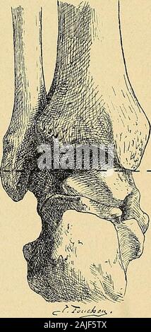 Technik du traitement des tumeurs Blanches. Abb. 154. - Ossifikation de lépiphyse du Abb. 155. - Ossifikation chez un Jeune Homme de Tibia chez un enfant de Cinq ans. dix-sept ans.. Stockfoto