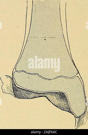 Technik du traitement des tumeurs Blanches. Abb. 154. - Ossifikation de lépiphyse du Abb. 155. - Ossifikation chez un Jeune Homme de Tibia chez un enfant de Cinq ans. dix-sept ans. Stockfoto