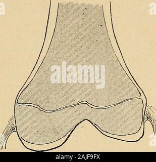 Technik du traitement des tumeurs Blanches. Fiff. 141. - Coupé transversale et bilatérale de Abb. 142. - Même coupé sur un sujetrex^-..iité fémur inférieure De sur un Sujet dix-sept ans (daprès Ollier).de cmq ans 1/2. Stockfoto