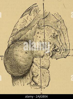 Ein text-Buch der Krankheiten des Ohres für Studierende und Praktiker. Er Urinarius. Am posteriorpart der Membrana tympani eine ovale Perforation gefunden wurde, durch whichseveral ragged Wucherungen ihren Weg gezwungen hatte. 766 KRANKHEITEN DES OHRES Eine unregelmässige, Sphäroguss, ovale Tumor von der Größe einer Orange war an der Schädelbasis, die die gesamte rechte petrousportion der zeitlichen Knochen belegt, und die nach vorn verlängerten in die rightmiddle und rückwärts in der hinteren Schädelgrube, alsodiscovered. Es war erstarrt in manchen Teilen, während in anderen scharfe Grate in den Projektionen zufolge Stockfoto