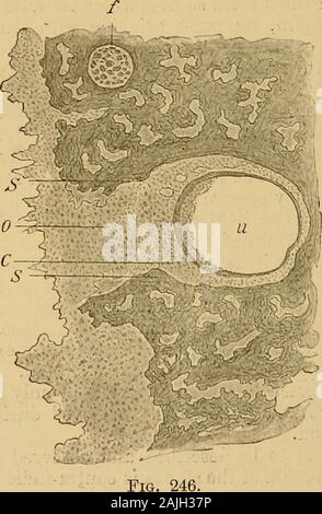Ein text-Buch der Krankheiten des Ohres für Studenten und Praktiker. R Kind schließlich starb an Tuberkulose der. Lungen, und das histologicalexamination der Orgel von Anhörung zeigte folgende (Abb. 246): Therecess des ovalen Fenster war mit Granulation Massen, die grewinto Vestibül gefüllt. füllte die gesamte Cisterna - perilyraphatica (c) und surroundedthe entzündliche verdickte Prostaticus auf allen Seiten, auf die er firmlyunited wurde (Abb. 246). Die retikulären Bindegewebe zwischen der membranousand knöchernen Bogengänge mit den Produkten der inflam unterwandert war. Stockfoto