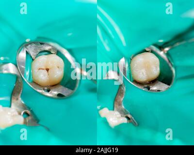 Karies. Befüllen mit zahnmedizinischen Composite photopolymer Material mit rabbders. Das Konzept der zahnärztlichen Behandlung in einer Zahnklinik Stockfoto