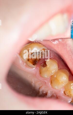 Karies. Befüllen mit zahnmedizinischen Composite photopolymer Material mit Kofferdam. Das Konzept der zahnärztlichen Behandlung in einer Zahnklinik Stockfoto