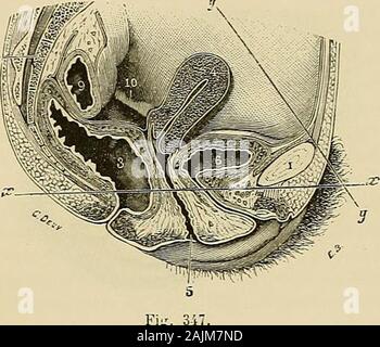 "Traité d'anatomie humaine: beschreibende Anatomie, Histologie, Développement. À sommet nettement marqué; 2° laxetotal de lutérus (ax du Corps et Ax du Col réunis) est une ligne weiterhin et légè-Rement arquée, dont La concavité regarde La face antérieure de lorgane: Le corpsde lutérus est donc un peu incliné sur le Col; ce-nest pas une vraie antéflexion, Mais, gießen Arbeitgeber lexpression Classique, une antécourbure; 3 Mez ax, quandlutérus est en position normale, répond à laxe de lexcavation: Sa concavité parconséquent regarde la Symphyse pubienne, Tandis que Le fond de lutérus sedirige en Stockfoto