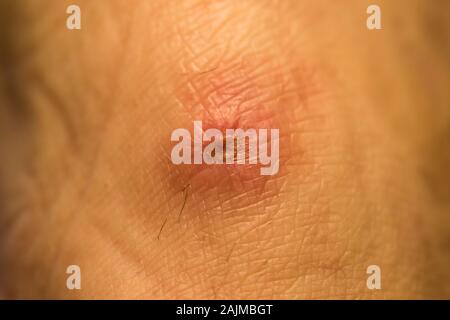 Close up oder dekubitus Dekubitus durch eine Form auf gebrochenes Bein getragen wird. Makro Blick auf hautulzerationen auf die Epidermis. Ulkus Schorf zu Fuß. Stockfoto