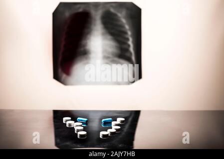 Tuberkulose Behandlungskonzept. Röntgenaufnahme der Lunge, mit Pathologie, phonendoscope mit Pillen auf den Tisch. Lungenerkrankung. Lungenentzündung. Medizinische Flatley, p Stockfoto