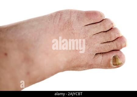 Nahaufnahme von einem Fuß mit Arthritis, beschädigte Nägel, weil der Pilz und Fußpilz Stockfoto