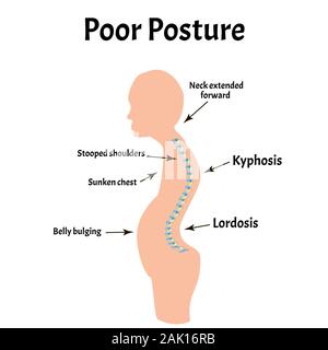 Falsche Körperhaltung Symptome. Text Hals Syndrom. Krümmung der Wirbelsäule, Kyphose, Lordose, Skoliose, Arthrose. Falsche Körperhaltung und Bücken. Infografiken Stock Vektor