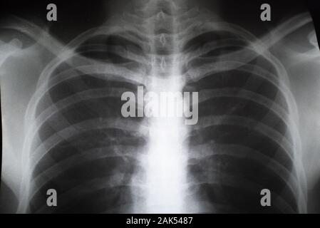 In der Nähe von X-ray Film der männlichen Teenager. Konzept der Gesundheitsversorgung Stockfoto