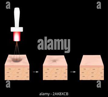 Aknenarben. Laser Narben atrophische Behandlung. Die anatomische Struktur der Haut mit Akne. Vector Illustration. Stock Vektor